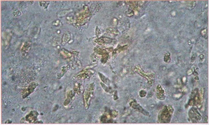 Клетки цилиндрического эпителия толстой кишки на фоне слизи. Фекалии больного с дистальным колитом Клетки цилиндрического эпителия толстой кишки на фоне слизи. Фекалии больного с дистальным колитом