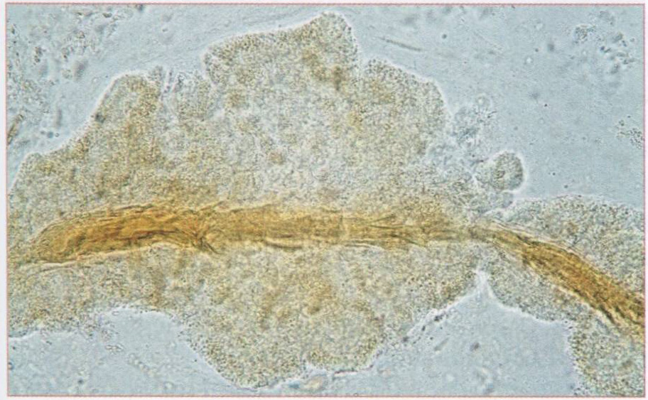 Рис. 180. Фрагмент слизистой тонкой кишки в кале ребенка 6 лет. Состояние после удаления толстой кишки. х400 Рис. 180. Фрагмент слизистой тонкой кишки в кале ребенка 6 лет. Состояние после удаления толстой кишки. х400