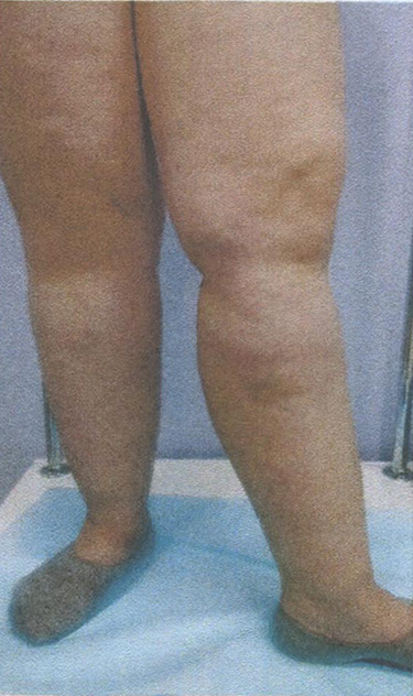 Липедема. Отложение жира, имитирующее отёки Липедема. Отложение жира, имитирующее отёки