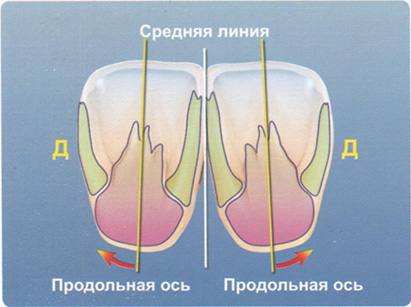 Выравнивание оральной поверхности по продольной оси