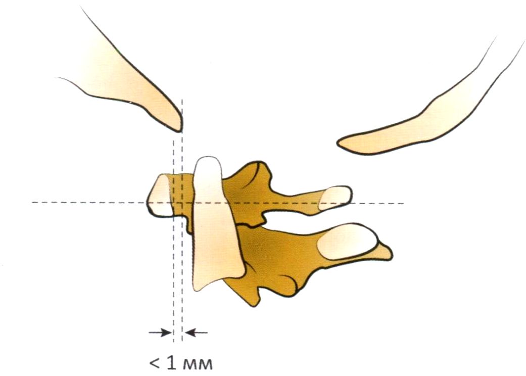  Метод оценки атланто-окципитальной нестабильности Визеля&mdash;Ротмана