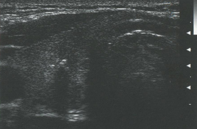 Акустическая тень. Тень наблюдается позади грубого кальцината в паренхиме щитовидной железы Акустическая тень. Тень наблюдается позади грубого кальцината в паренхиме щитовидной железы