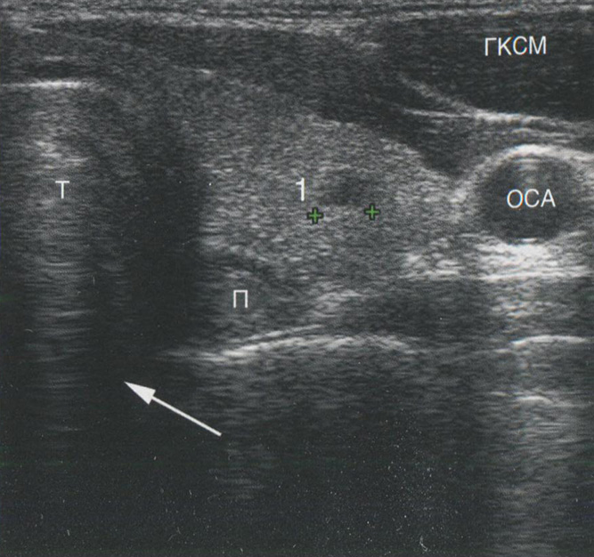 Акустическая тень. Область кзади от трахеи не визуализируется во фронтальной проекции из-за очень высокого отражения на границе ткань-воздух Акустическая тень. Область кзади от трахеи не визуализируется во фронтальной проекции из-за очень высокого отражения на границе ткань-воздух