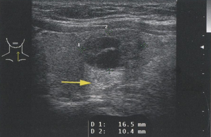 Усиление сигнала. Кистозные структуры проводят звук с незначительным затуханием Усиление сигнала. Кистозные структуры проводят звук с незначительным затуханием