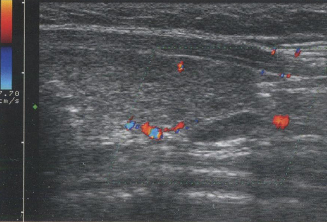 Усиление сигнала. Аденомы паращитовидных желез имеют сравнительно гомогенную ткань Усиление сигнала. Аденомы паращитовидных желез имеют сравнительно гомогенную ткань