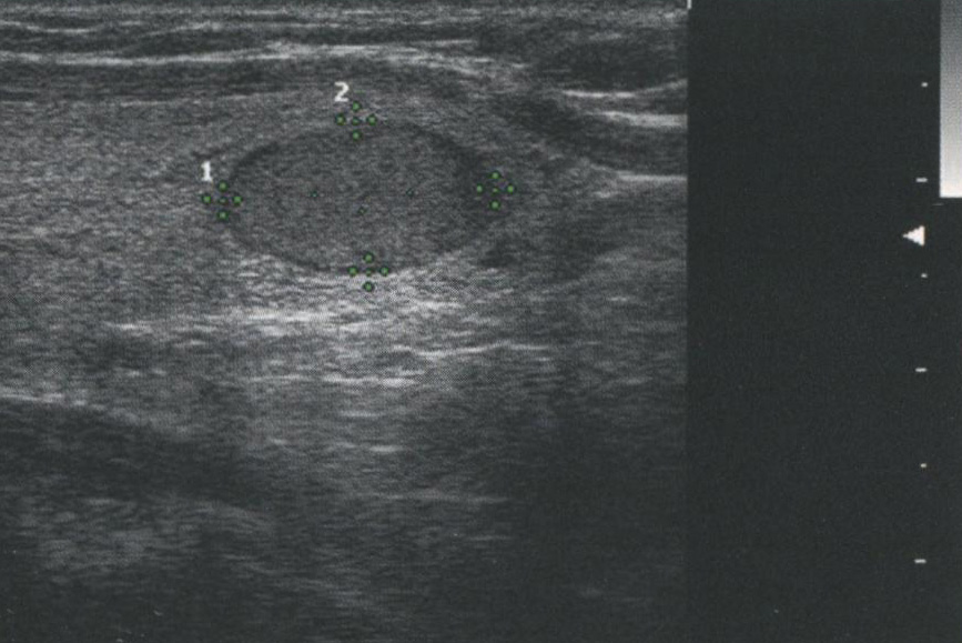 Усиление сигнала. Этот доброкачественный коллоидный узел содержит много жидкости и коллоида Усиление сигнала. Этот доброкачественный коллоидный узел содержит много жидкости и коллоида