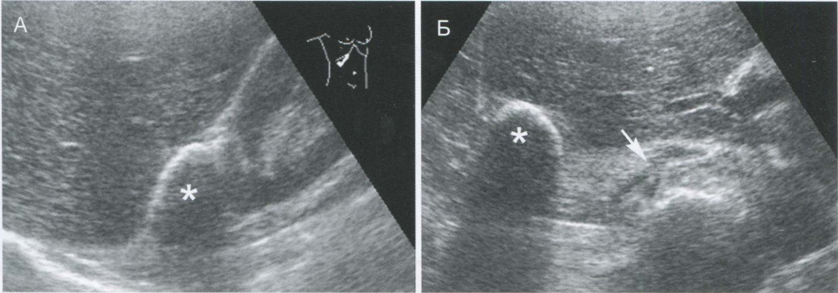  Кальцинат печени (*), ошибочно принятый при продольном сканировании (А) за кальцинат правого надпочечника.