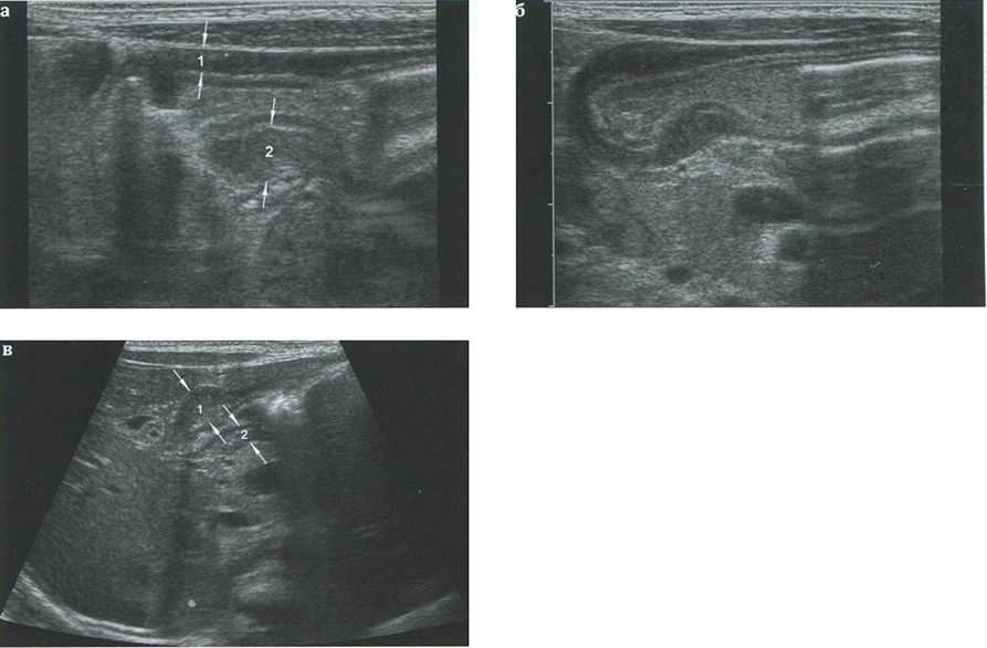 Асимметричная гипертрофия мышечного слоя при пилоростенозе