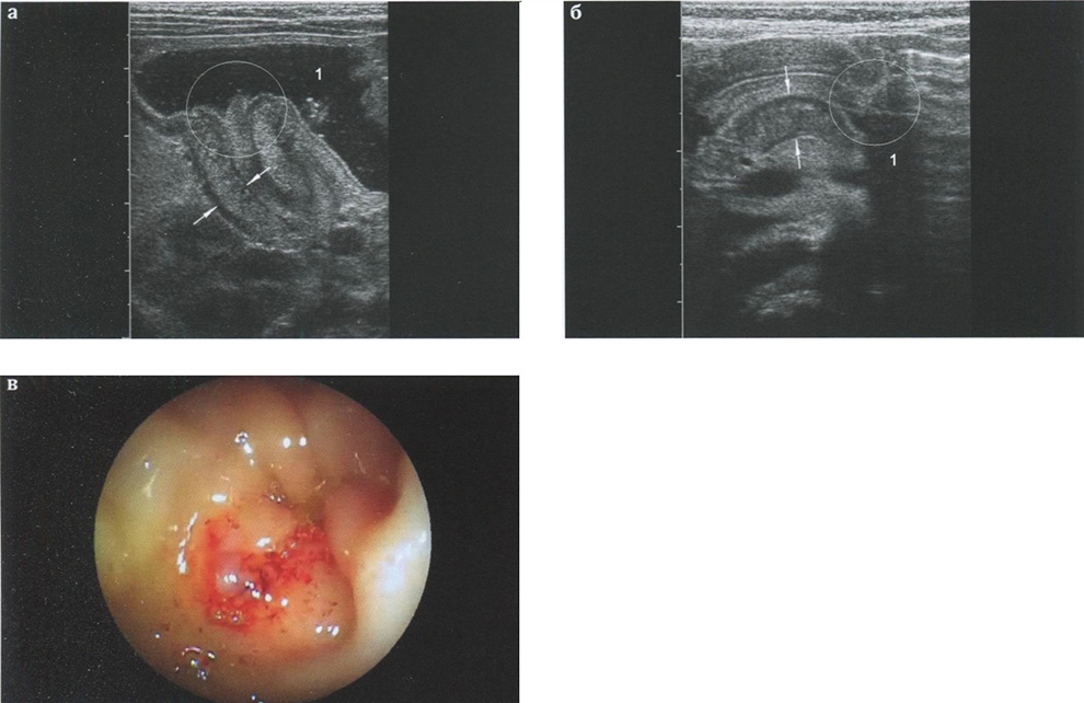 Особенности эхографической и эндоскопической визуализации входа в пилорический отдел желудка при гипертрофическом пилоростенозе 