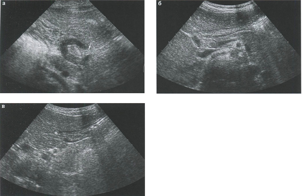Эхографическое представительство пилорического отдела желудка после пилоротомии (разные дети)