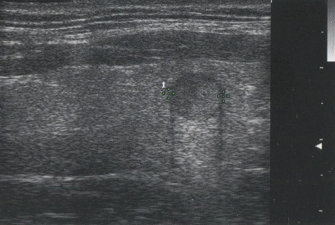 Краевой артефакт. Видны темные линии, распространяющиеся кзади Краевой артефакт. Видны темные линии, распространяющиеся кзади