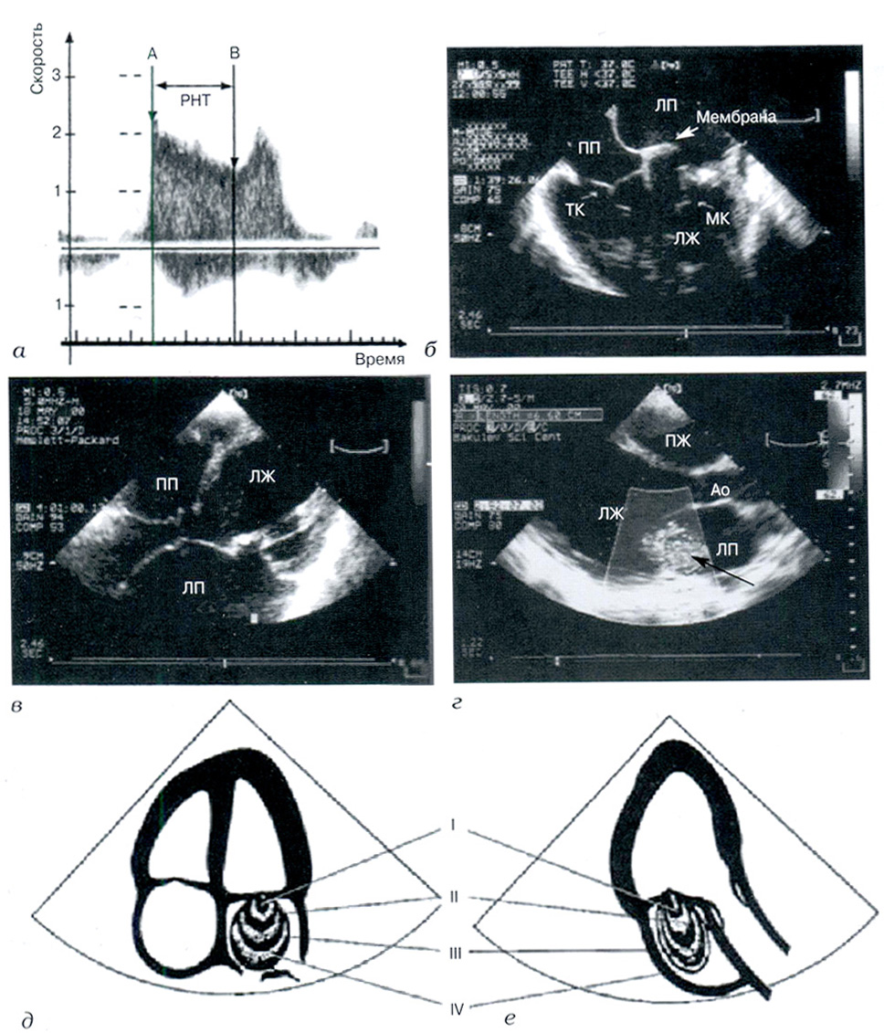 Рис. 2. Допплерография и двухмерное эхокардиографическое исследование в оценке патологии митрального клапана
