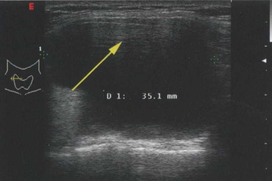 Артефакт реверберации Артефакт реверберации