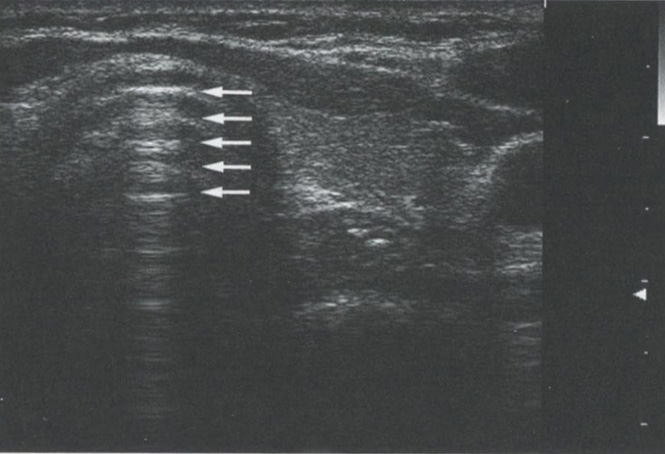 Артефакт реверберации. Видно большое количество параллельных линий кзади от передней стенки трахеи Артефакт реверберации. Видно большое количество параллельных линий кзади от передней стенки трахеи