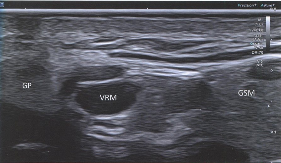 Позадинижнечелюстная вена (v. retromandibularis; VRM) прободает околоушную железу (GP) и служит ключевым внутренним ориентиром для поиска шейной 