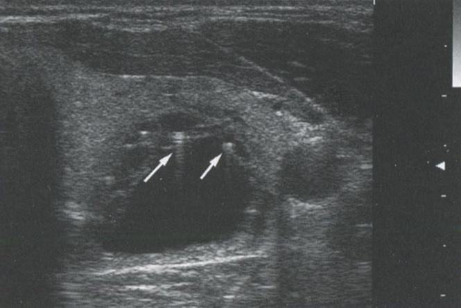 «Хвосты комет». Коллоидные узлы могут содержать тонкие кристаллы «Хвосты комет». Коллоидные узлы могут содержать тонкие кристаллы