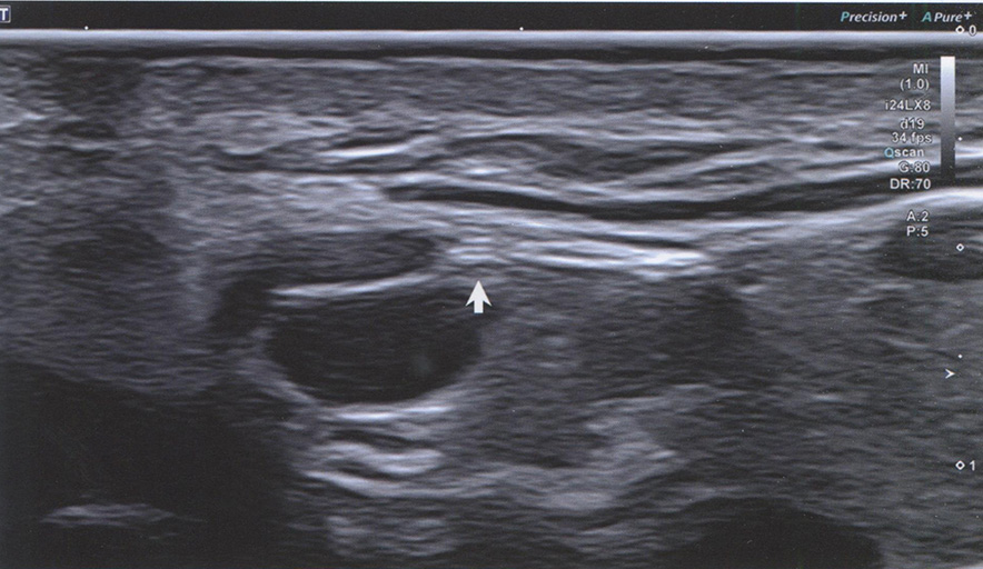 ТОВ шейной ветви лицевого нерва (стрелка) располагается сверху и кпереди от позадинижнечелюстной
