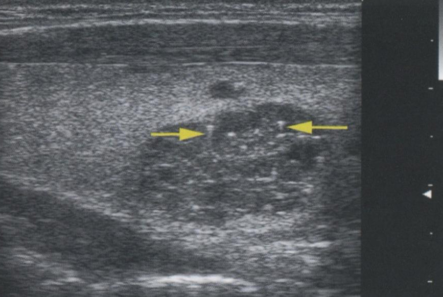 «Хвост кометы». Еще один пример артефакта «хвост кометы» в доброкачественном коллоидном узле «Хвост кометы». Еще один пример артефакта «хвост кометы» в доброкачественном коллоидном узле