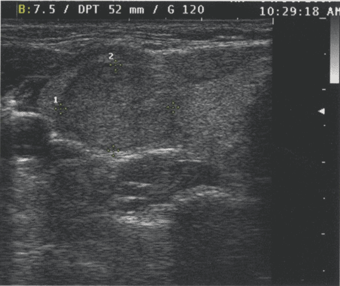 Сравнение изображений, сделанных при частоте в 7,5 и 13 МГц. Сравнение изображений, сделанных при частоте в 7,5 и 13 МГц.