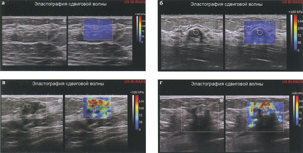 Рис. 2. Эластография сдвиговой волны. Варианты картирования ткани молочной железы: