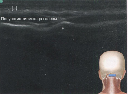 Скан затылочного бугра (*). Стрелки указывают на поверхностную фасцию волосистой части головы