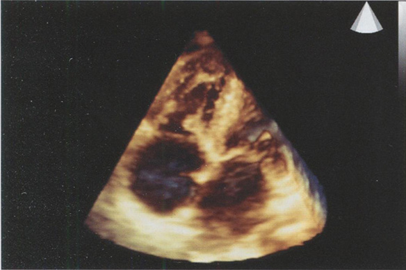 Апикальная четырехкамерная позиция в норме Апикальная четырехкамерная позиция в норме