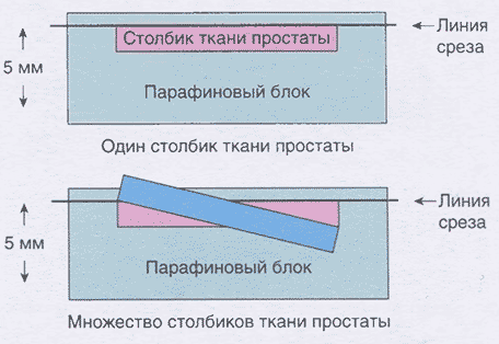 При заливке нескольких столбиков в парафиновый блок отмечается неравномерное расстояние относительно горизонтальной линии среза