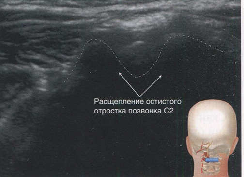  Скан на уровне позвонка С2. (Напечатано с разрешения Филипа Пенга. Образовательная серия)