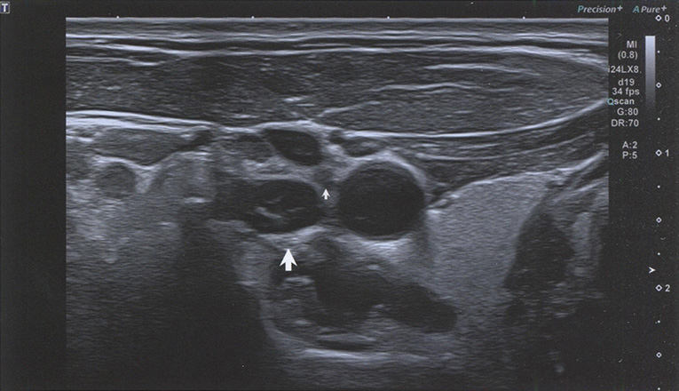  Средний шейный узел (стрелка) визуализируется в области ТОВ (между сосудами и превертебральными мышцами)