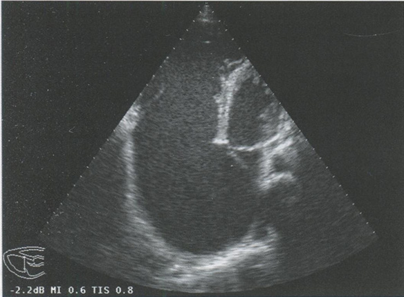 Апикальная четырехкамерная позиция. Аномалия Эбштейна Апикальная четырехкамерная позиция. Аномалия Эбштейна