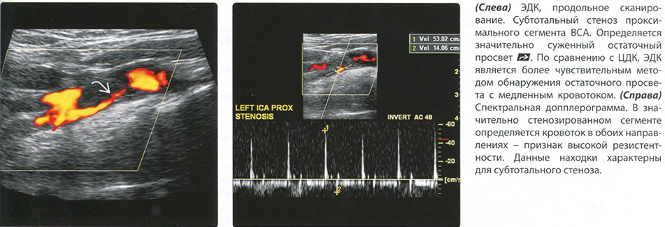 УЗИ диагностика. Стеноз сонной артерии. Окклюзия сонной артерии