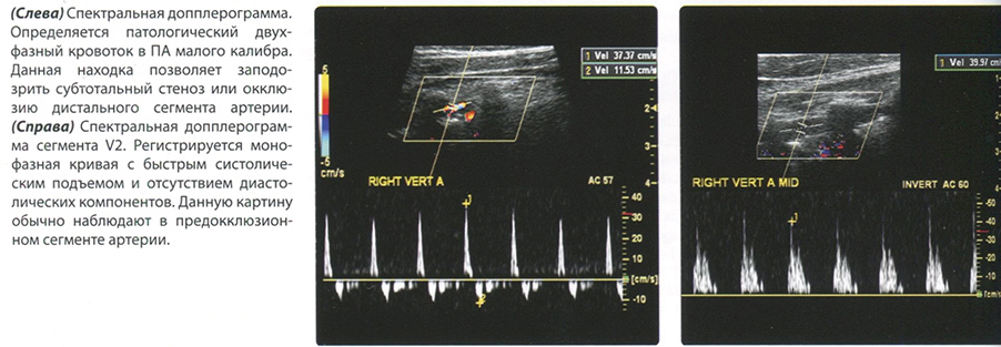 УЗИ диагностика Стеноз позвоночной артерии. Окклюзия позвоночной артерии.