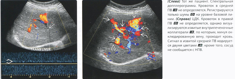 УЗИ диагностика. Синдром Бадда-Киари