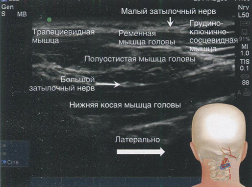 Скан на уровне позвонка С2 с латеральным концом датчика