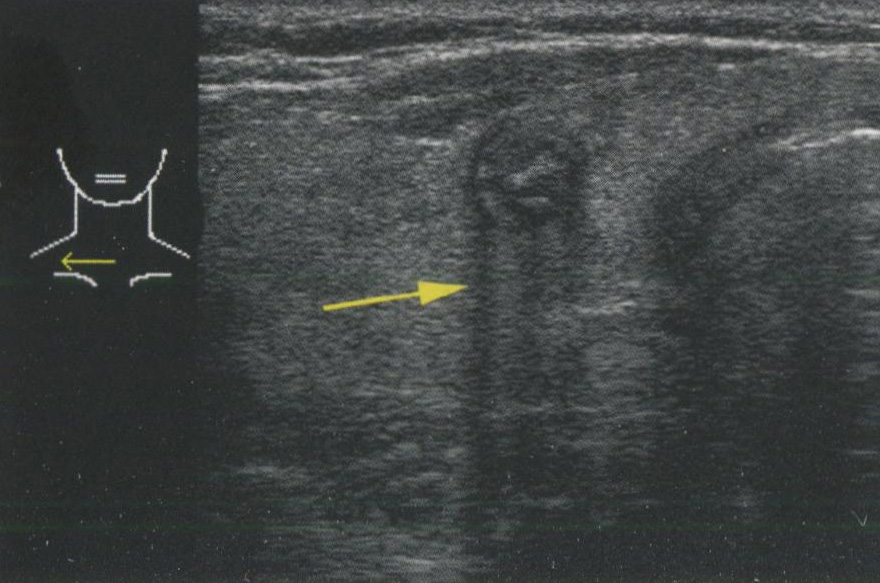 Акустическая тень. Когда звуковые волны попадают на область с выраженной разницей акустического импеданса, например, на границу ткань-воздух или на кальцинат Акустическая тень. Когда звуковые волны попадают на область с выраженной разницей акустического импеданса, например, на границу ткань-воздух или на кальцинат