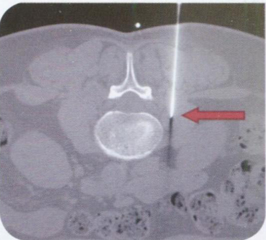 КТ-изображение большой поясничной мышцы (m. psoas major)