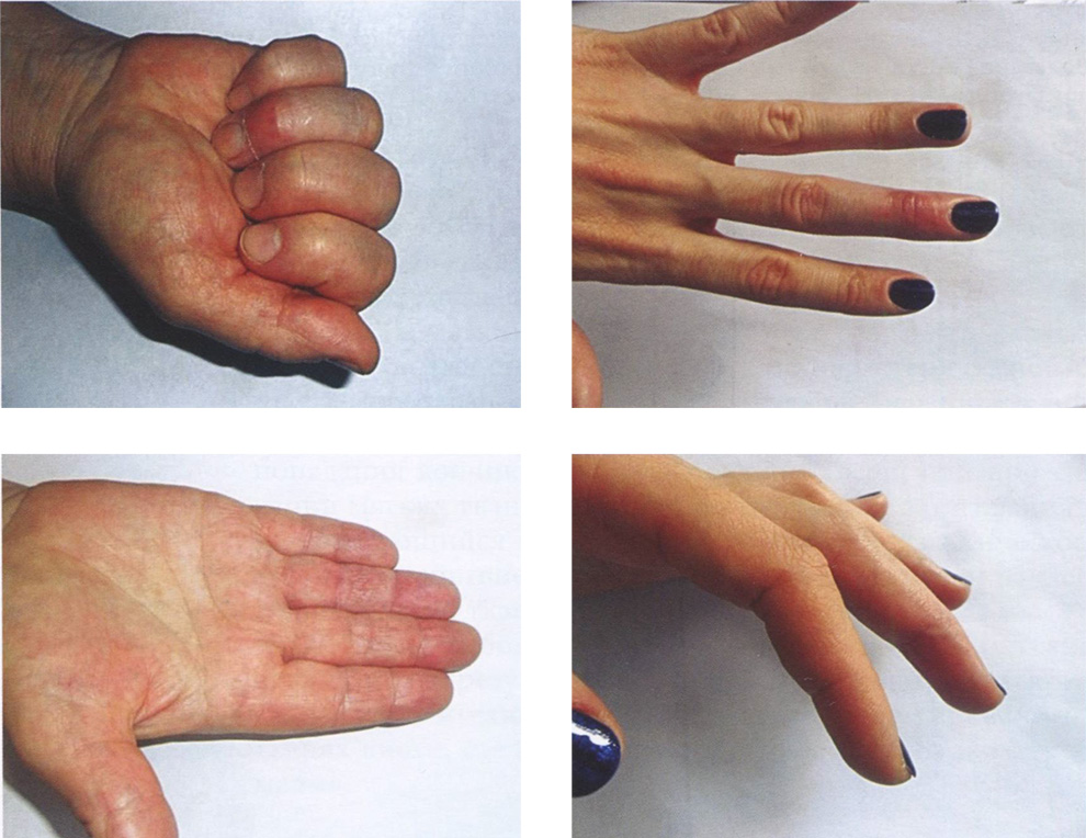 Результаты лечения подкожных разрывов сухожилия разгибателей пальцев кисти в зоне