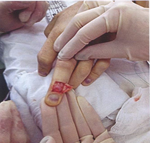 П-образный доступ к сухожилию разгибателей пальцев кисти в зоне 