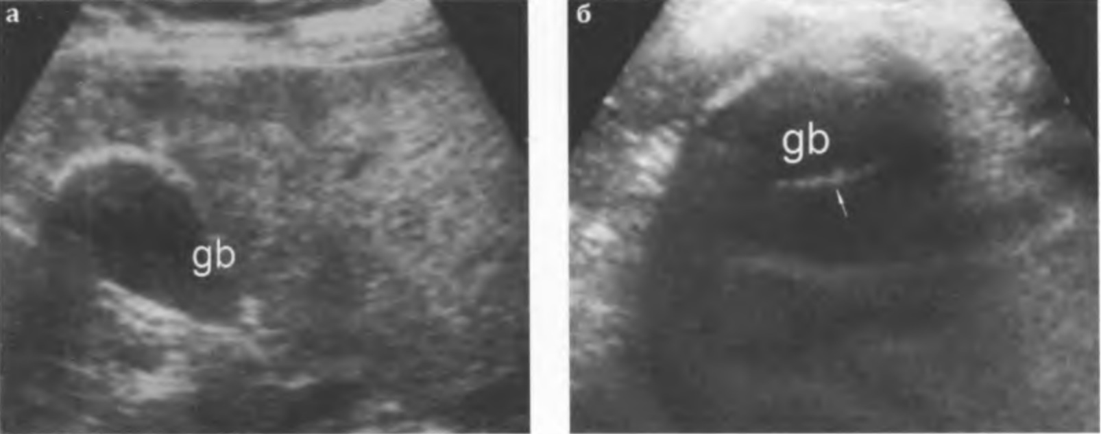  "Фарфоровый" желчный пузырь (значительное повышение эхогенности стенки желчного пузыря (gb), за стенкой определяется акустическая тень)