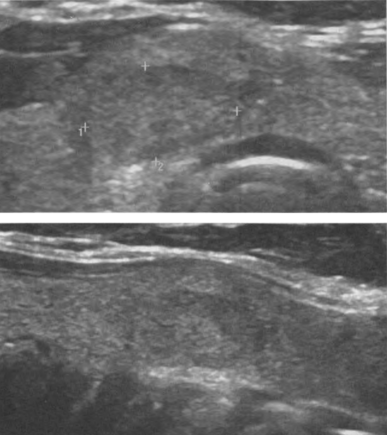 Узел 11х6, 4х12,1 мм правой части перешейка ЩЖ у пациентки 44 лет