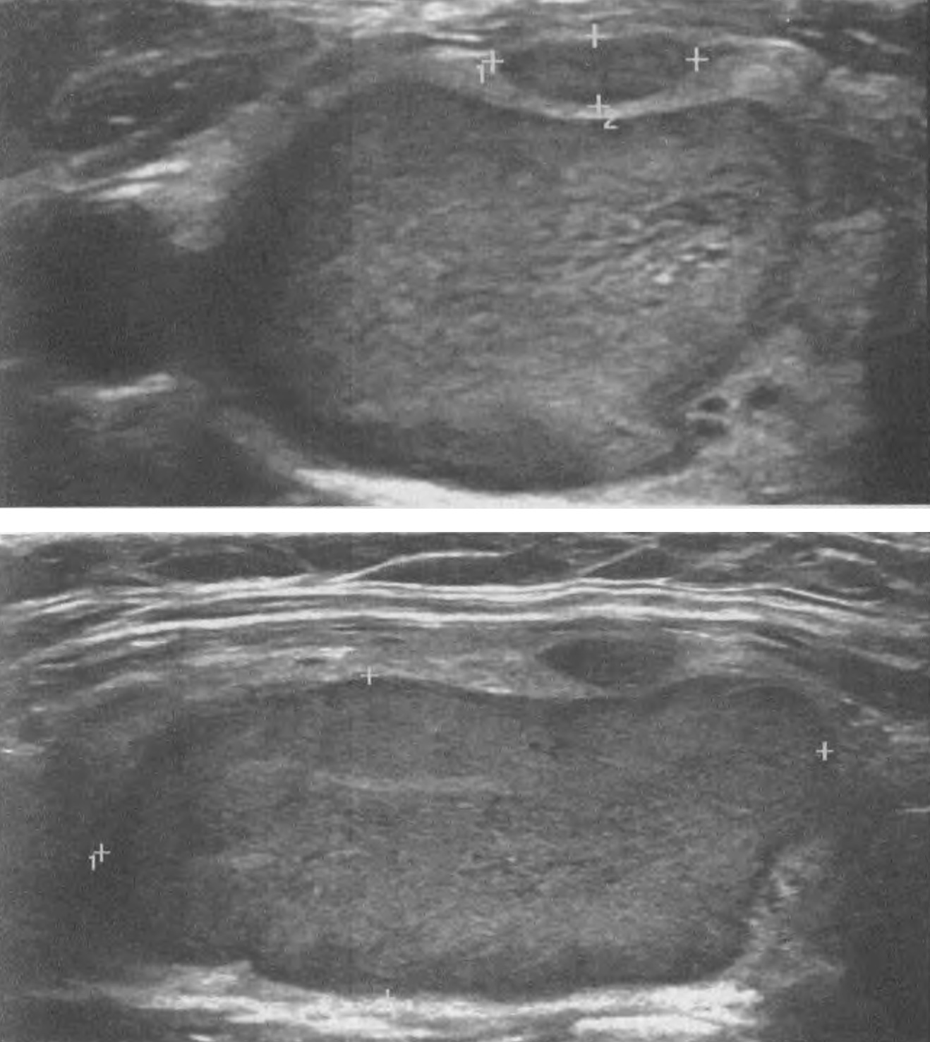  Узел 38, 2х17, 3х24,2 мм правой доли ЩЖ у пациентки 60 лет