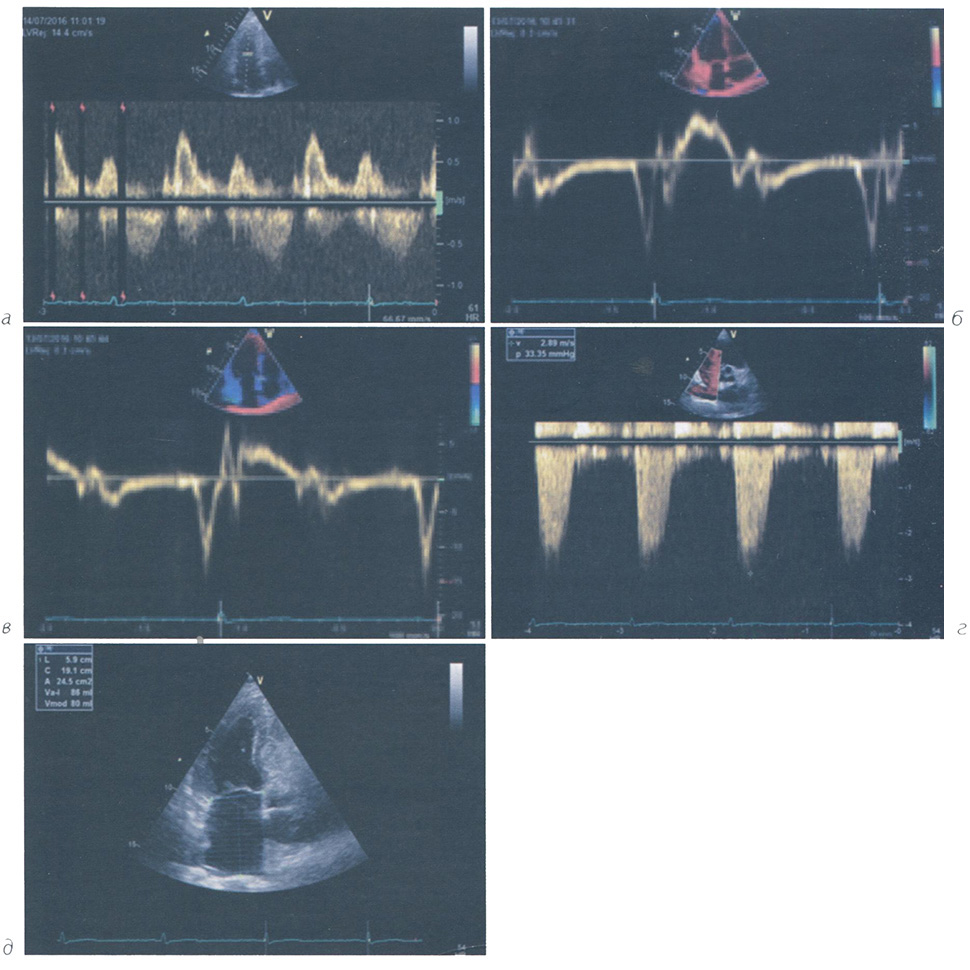 Измерения, необходимые для суждения о наличии ДД ЛЖ у пациентов с нормальной фракцией выброса ЛЖ