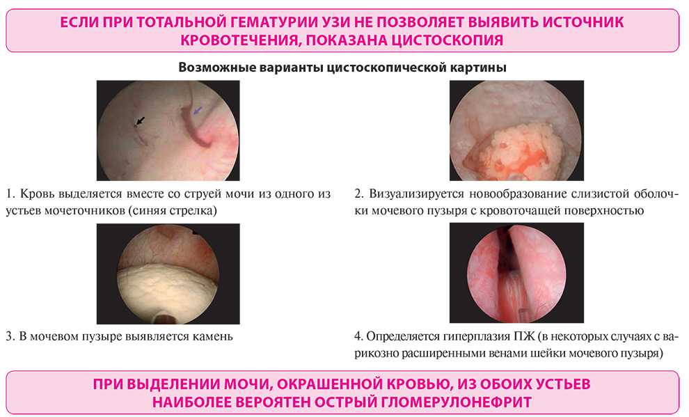 Если при тотальной гематурии УЗИ не позволяет выявить источник кровотечения, показана цистоскопия