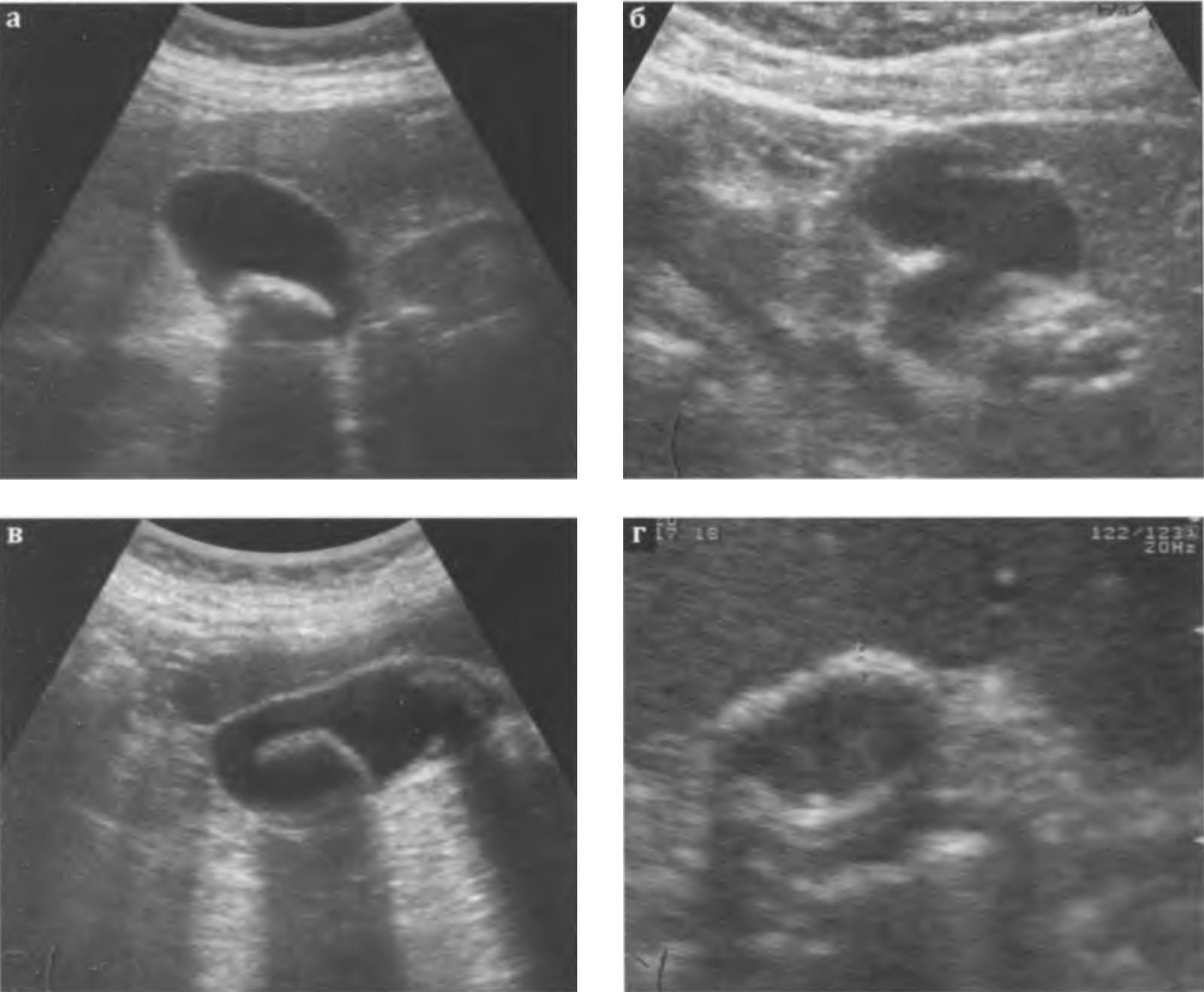 Хронический калькулезный холецистит: а,б,в - стенка желчного пузыря повышенной эхогенности