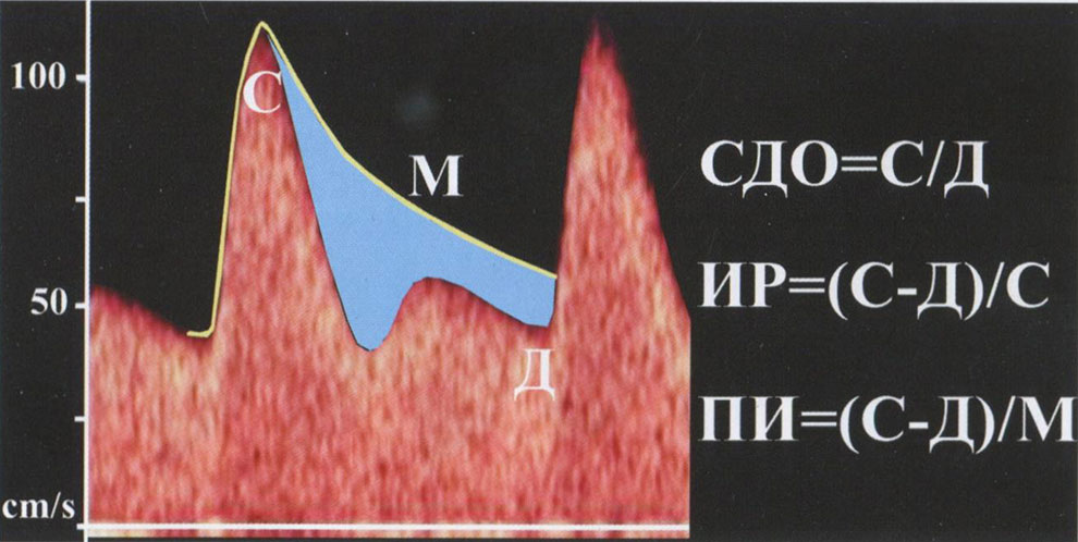  Расчет индексов при оценке КСК в маточных артериях