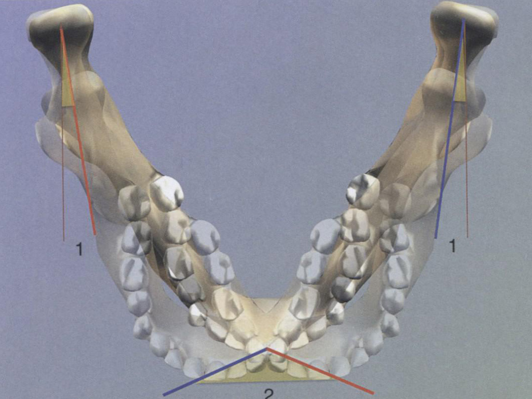 Боковые движения нижней челюсти (угол Беннетта &mdash; 1 и готический угол &mdash; 2)