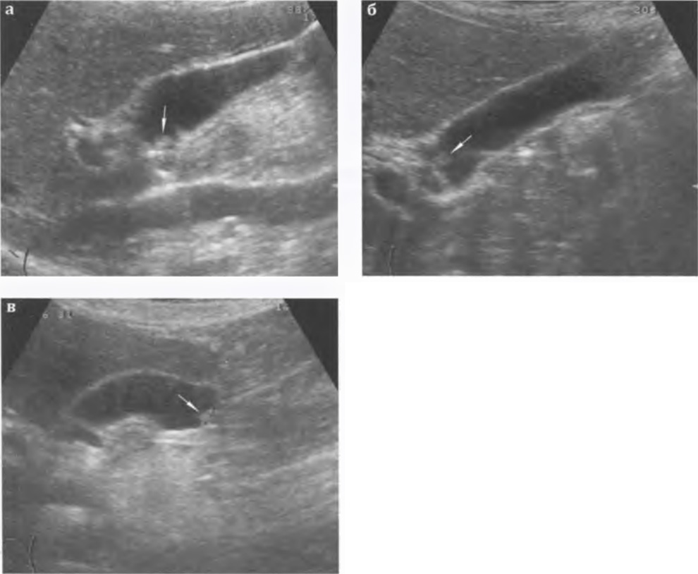  Холестероз стенок желчного пузыря: различная локализация полипа (стрелка).
