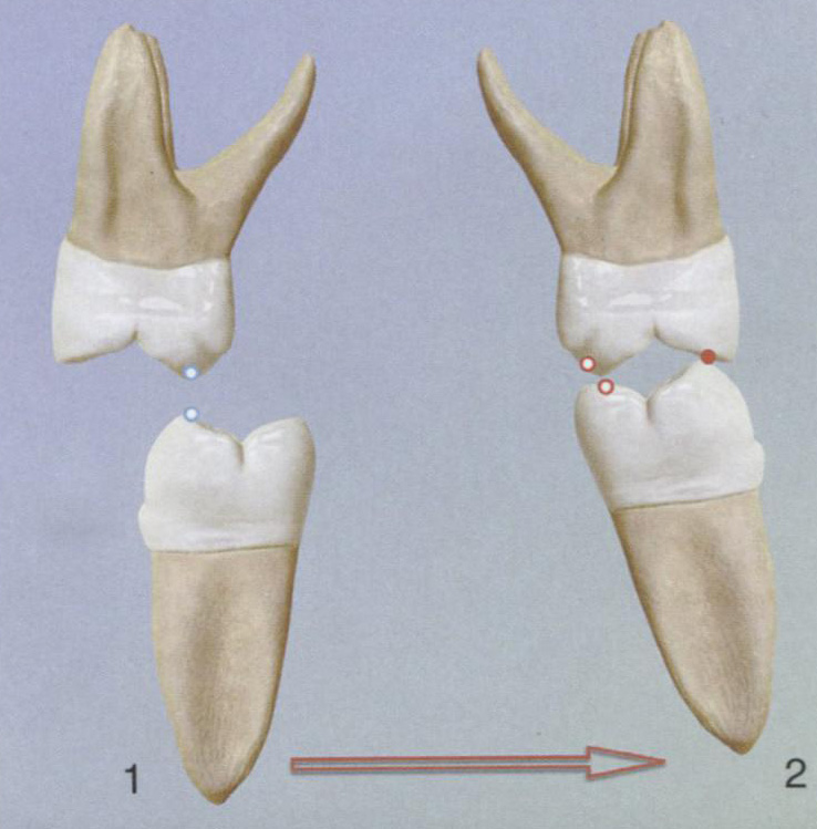  Характер смыкания боковых зубов при левой боковой окклюзии без балансирующих контактов