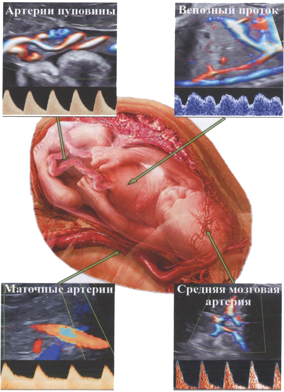 Схематическое изображение изучения КСК в маточных артериях, артериях пуповины, венозном протоке и средней мозговой артерии плода