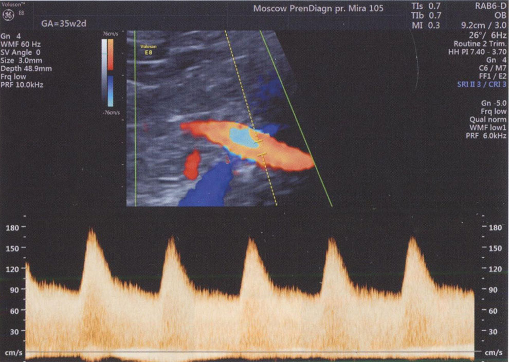 Исследование кровотока в маточной артерии в 35 недель 2 дня